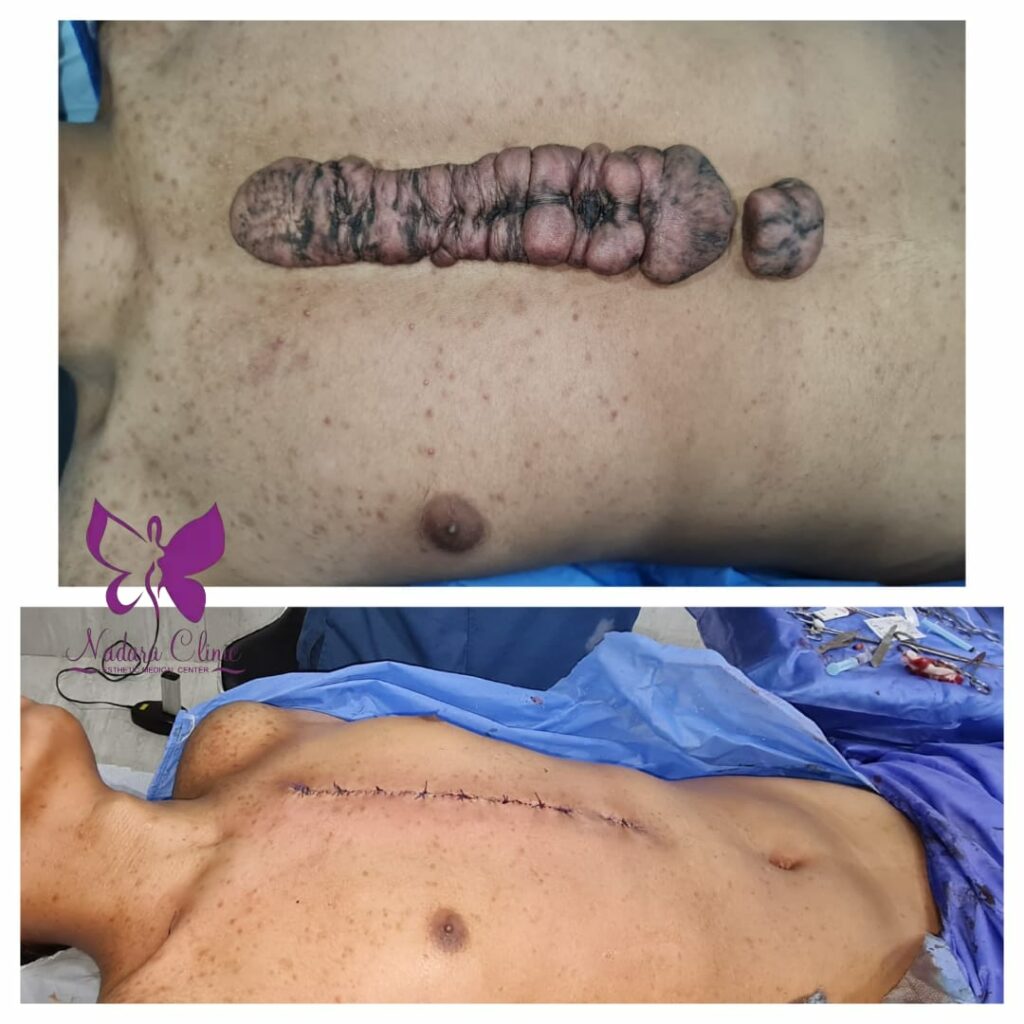 Getting rid of fibrosis (cold) in Hurghada